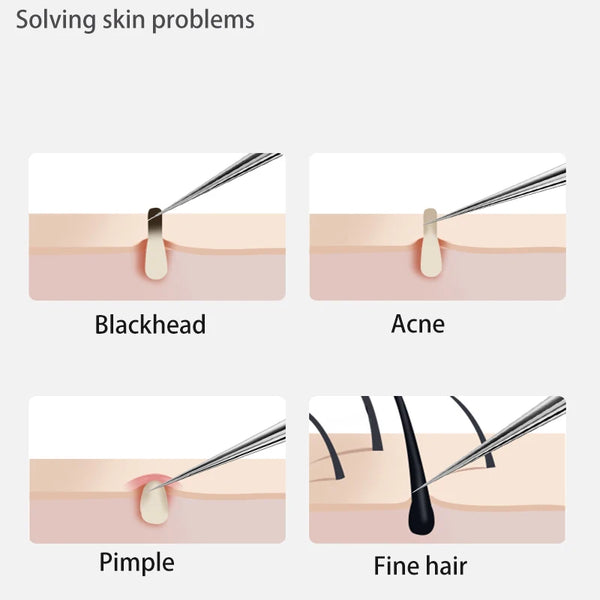Acne Blackhead Removal Needles Stainless Steel Black Spot Blemish Pimple Removal Needle Deep Cleansing Tool Face Skin Care Kit